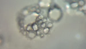 CBD et cancer des ovaires : un nouvel espoir de traitement ?